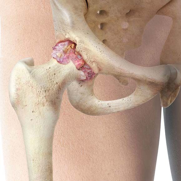 Total Hip Joint Replacement - Dr. Daniel C. Eby - Orthopedic