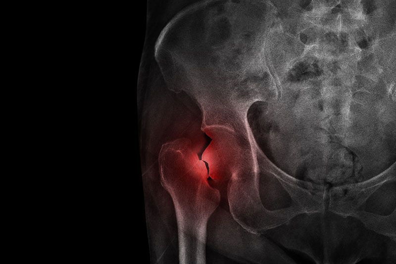 Total Hip Joint Replacement - Dr. Daniel C. Eby - Orthopedic Surgery &  Sports Medicine